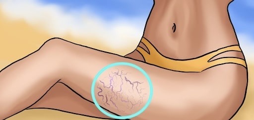 Varicose veins